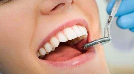 Çürük diş hansı xəstəliklərə səbəb olur?