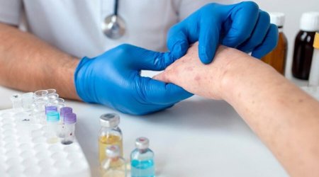 Azərbaycanda qızılcaya yoluxmalarla bağlı SON VƏZİYYƏT