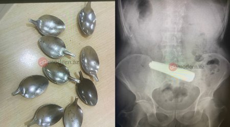 Bakı sakini 9 ədəd qaşıq uddu – FOTO