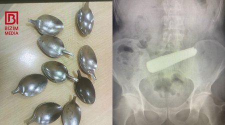 Bakıda 9 ədəd qaşıq udan şəxsin 55 yaşı var – TƏFƏRRÜAT