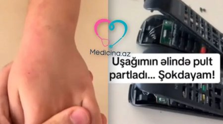 Bakıda azyaşlının əlində pult partladı