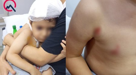 Masazırda 2 yaşlı uşağı it dişlədi – FOTO