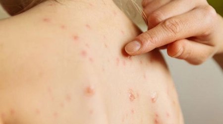 Ötən il qızılca və suçiçəyi keçirənlərin sayı açıqlandı
