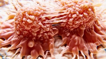 Xərçəngin müalicəsində İNQİLAB: Şişlər 30 dəqiqəyə məhv edilir