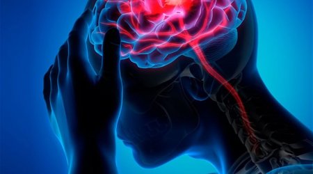 İnsult kasıb insanlarda daha çox rast gəlinir – ALİMLƏRİN QƏNAƏTİ