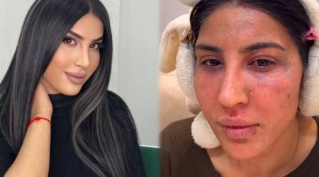 Reklam etdiyi pilinq Ləmanın üzünü yandırdı