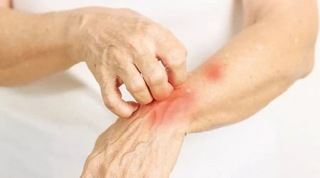 Tarixə gömdüyümüzü düşünürdük, yenidən dirildi &ndash; Cüzam epidemiyası geri qayıdır?