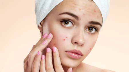 Sızanaqlardan təbii yollarla qurtulmağın effektiv üsulları