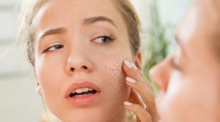 Dəriniz qurudursa bu meyvələrdən uzaq durun