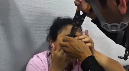 Göz qapağına geyiminin zəncirbəndi ilişdi - VİDEO