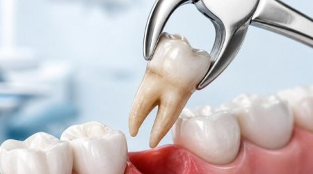 Stomatologiyanın &ldquo;səhnə arxası&rdquo; &ndash; Çəkilən çürük dişlər hara gedir?
